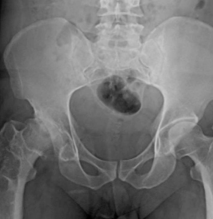 Total Hip Replacement.