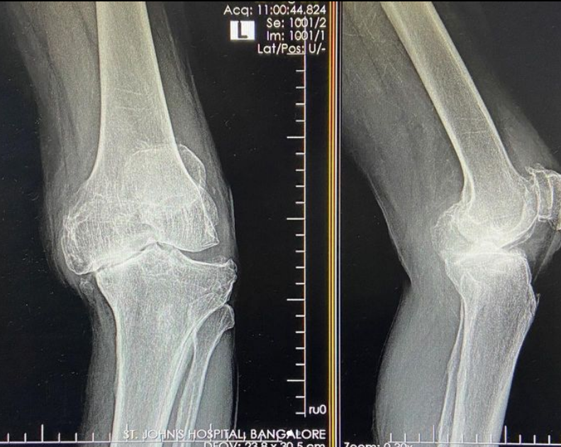 Total Knee Replacement